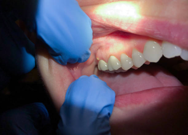 Best Emergency Denture Repair in Broad Creek, NC